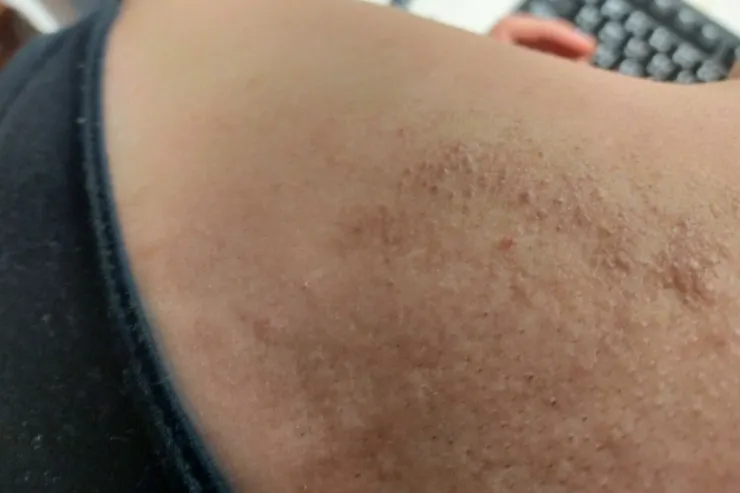 這是比較嚴重的時候。 皮膚會抓到 變黑又變硬 就是很癢、很癢......