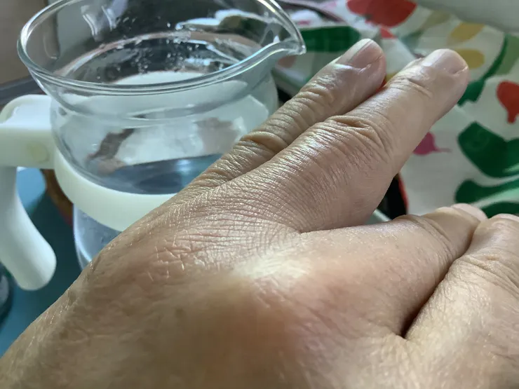 圖三：事發後第三天恢復90%