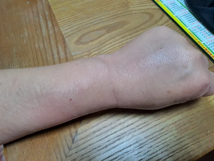 蒔緣左手背與左前臂，也淪陷了。