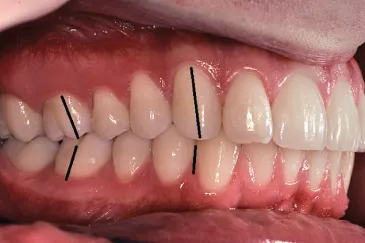 第一類咬合 class I