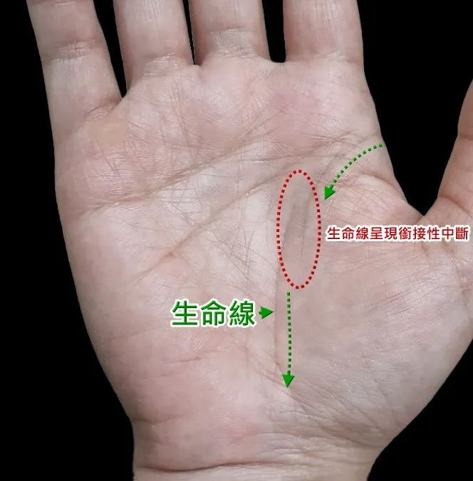生命線呈現銜接性中斷