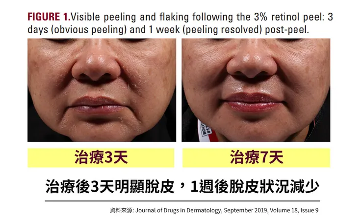 「A醇」現代抗老神器！