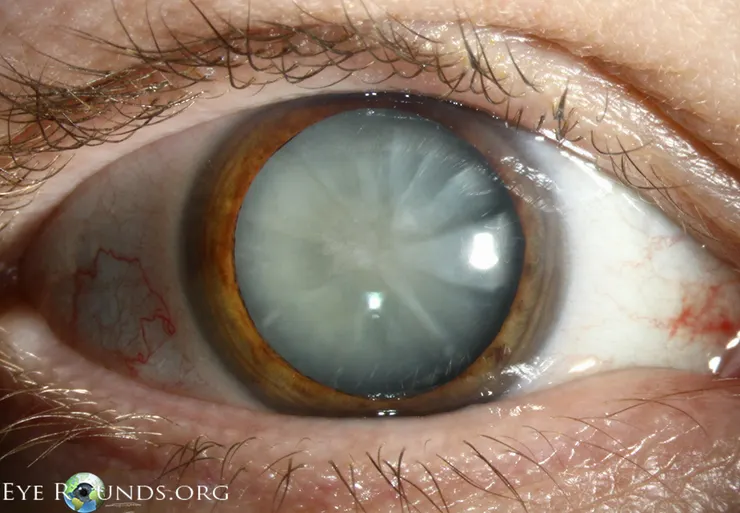 Age-Related Cortical Cataract-eye round