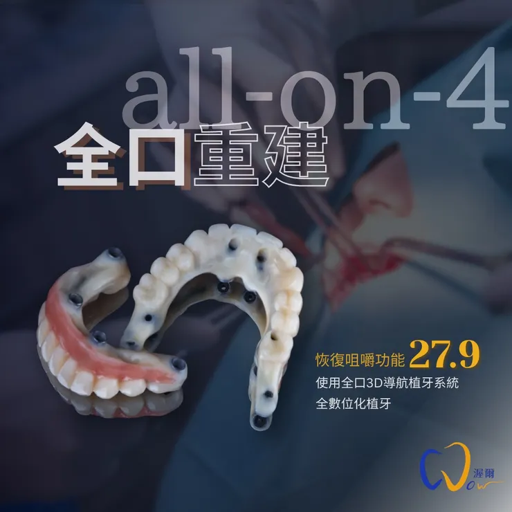 渥爾牙醫診所:【All-on-4全口重建】給你穩固、美觀又實惠的植牙選擇!重拾自信笑容!
