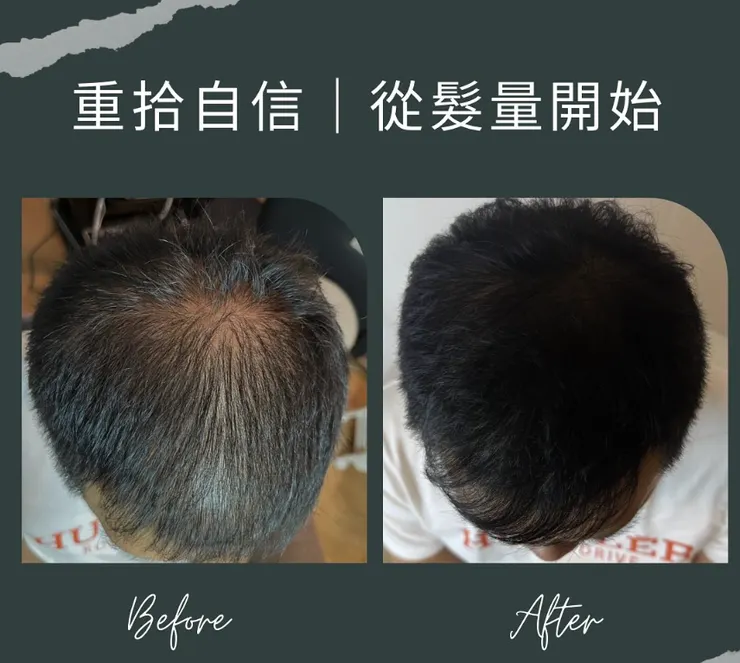 效果聲明： 「育髮調理需考量個人荷爾蒙、遺傳、生活壓力及飲食習慣等因素，故效果具有個體差異性，本所無法保證特定的生髮數量或時間。」