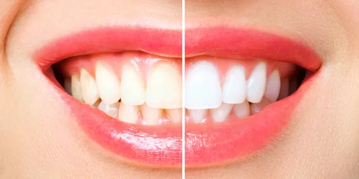 新竹森釉牙醫提供全瓷假牙與陶瓷貼片，打造自然美麗又持久的自信笑容!