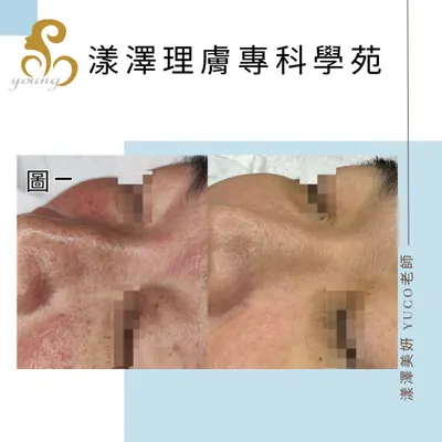 脂漏性皮膚炎-48歲逆齡反轉到30歲