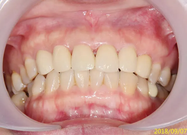 請注意開始是2017，花了一年多，才終於走到裝正式假牙