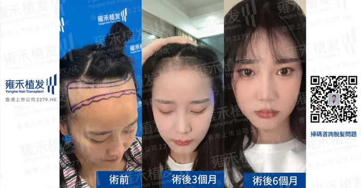 植髮效果