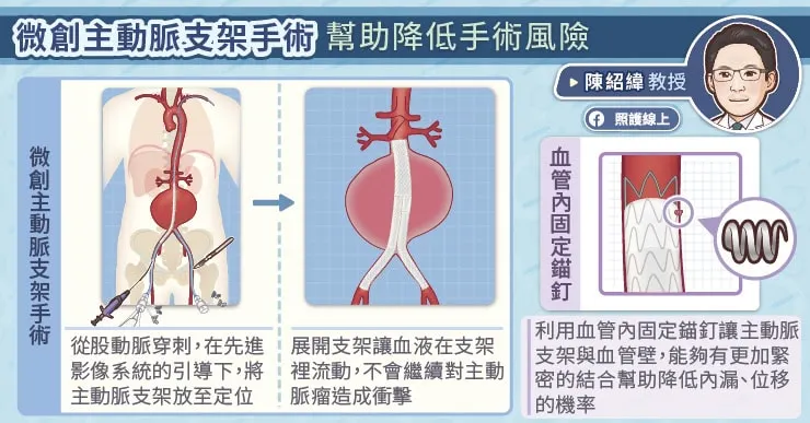 微創主動脈支架手術幫助降低手術風險