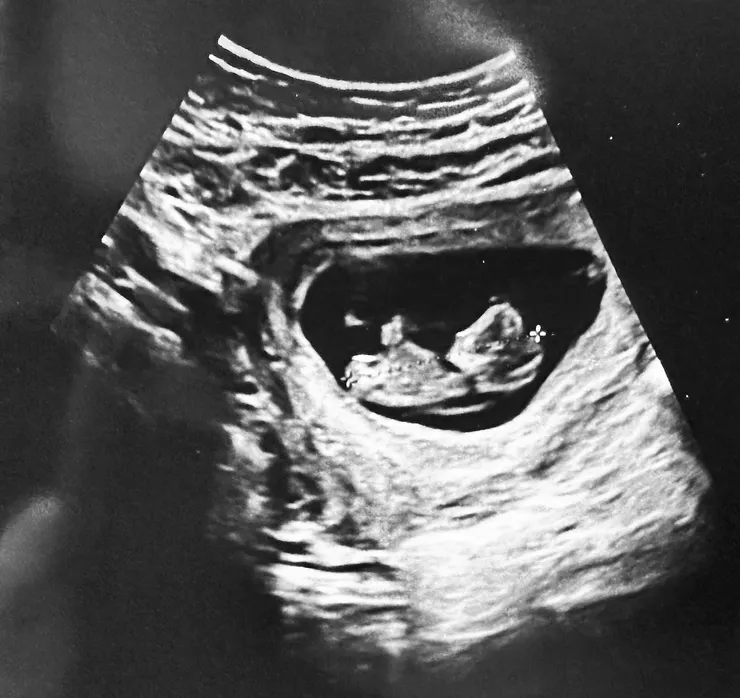 10w+4d,比起上次8w的肉團,已經看得出頭跟鼻子啦!