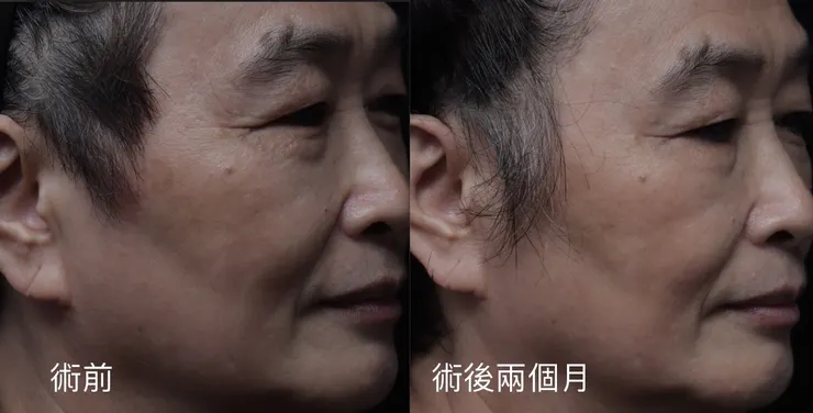 治療後2個月