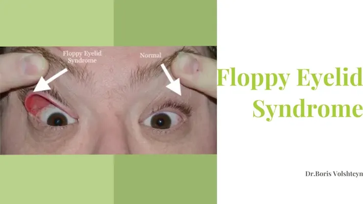 Floppy eyelid syndrome—Dr. Boris Volshteyn