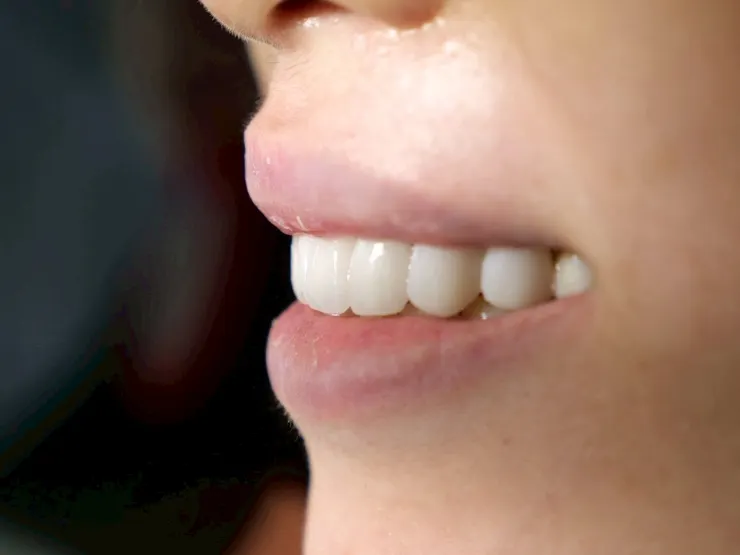 一笑傾城，氣質全開！客製化明眸鋯齒貼片(牙齒貼片)打造專屬你的自信笑容！