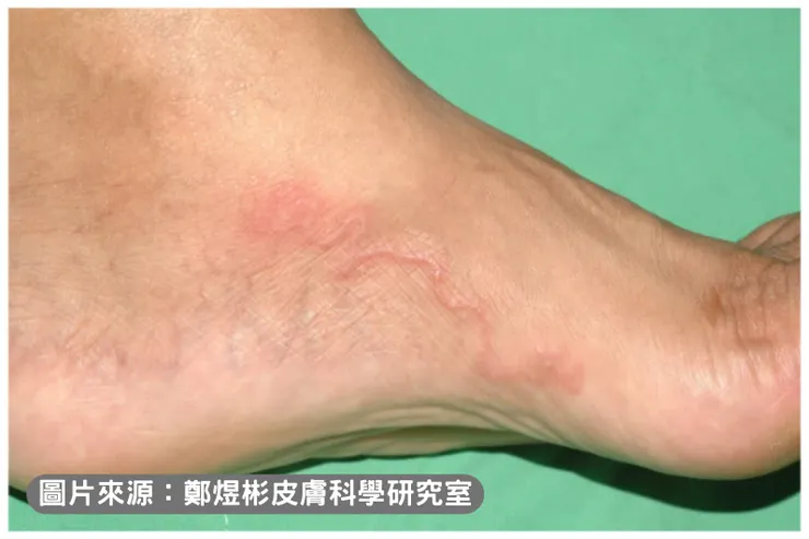 鉤蟲鑽過移行過的痕跡