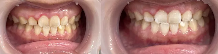 美齒師會拍攝前後照，想要留存的，都可以直接跟美齒師索取喔💕