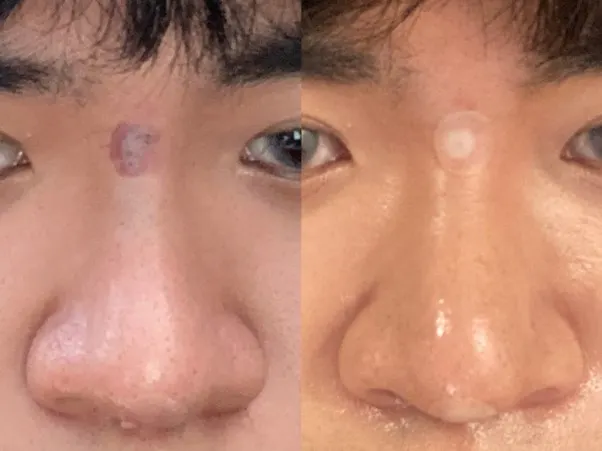 皮醫美陳裕豪醫師無痛筋膜多層次埋線拉提