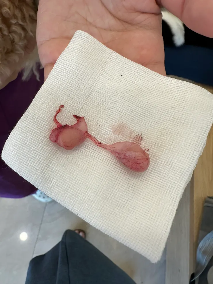 看起來好像迷你雞佛，聽說有人會留下來做成標本當紀念???還好護士沒問我要不要帶回家 