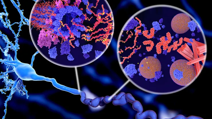 腦中堆積的類澱粉蛋白與 tau 蛋白
