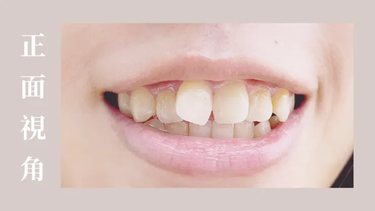 正面看起來門牙歪歪的
