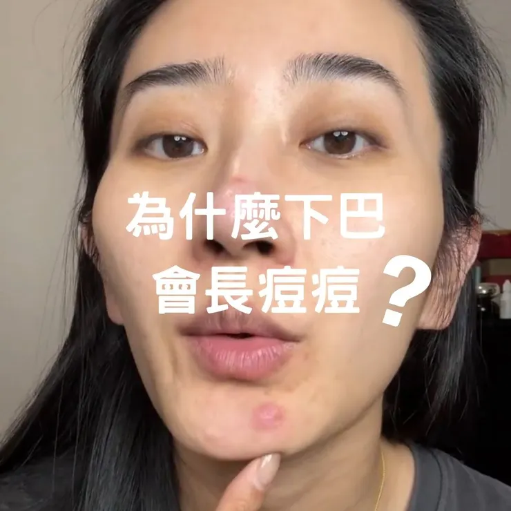 為什麼生理期下巴長痘痘