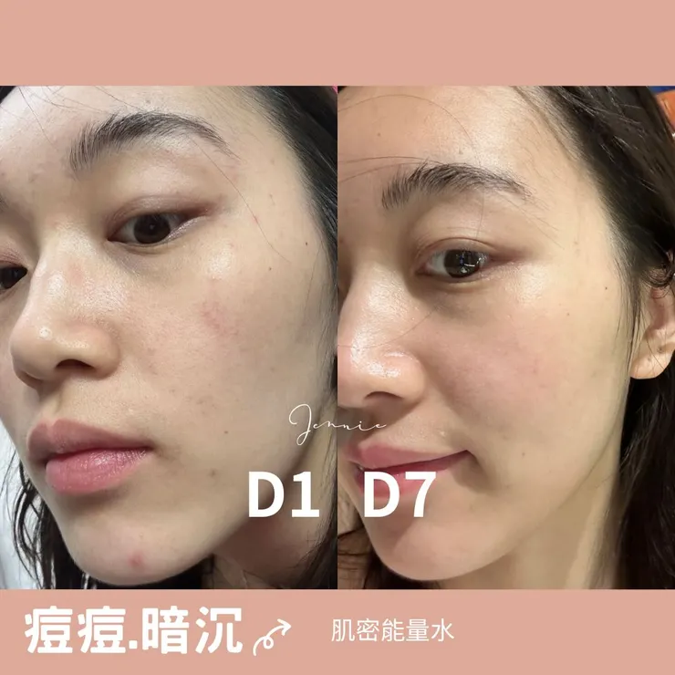 痘痘暗沉-ATLA肌密能量水