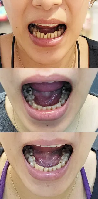 隱適美矯正紀錄 #除汞