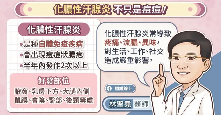 化膿性汗腺炎不只是痘痘