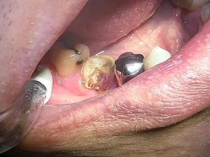 渥爾牙醫診所: Cap-Lock全瓷系列修復案例!斜裂下大臼齒的成功修復!