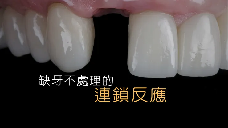 缺牙不補沒關係？小心這「一顆牙」引發全口連鎖反應！