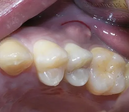 渥爾牙醫診所：小臼齒裂牙不拔牙，Cap-Lock全瓷修復保住原牙！