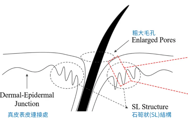 研究發現：粗大毛孔在DEJ處都伴隨有時筍狀(SL)結構...（引用自該報告Fig.1(A)）
