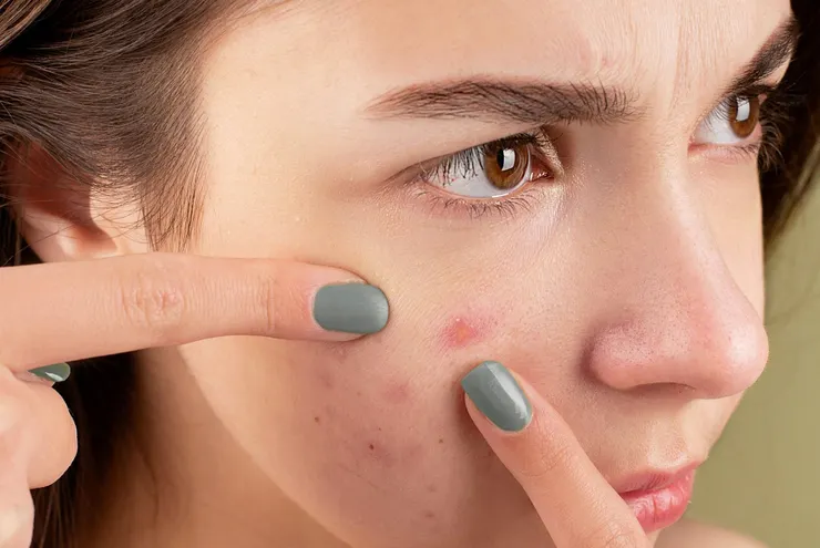 圖說：鮮奶及奶精中的成分，都可能成為長痘痘的原因。（資料來源：Pexels）