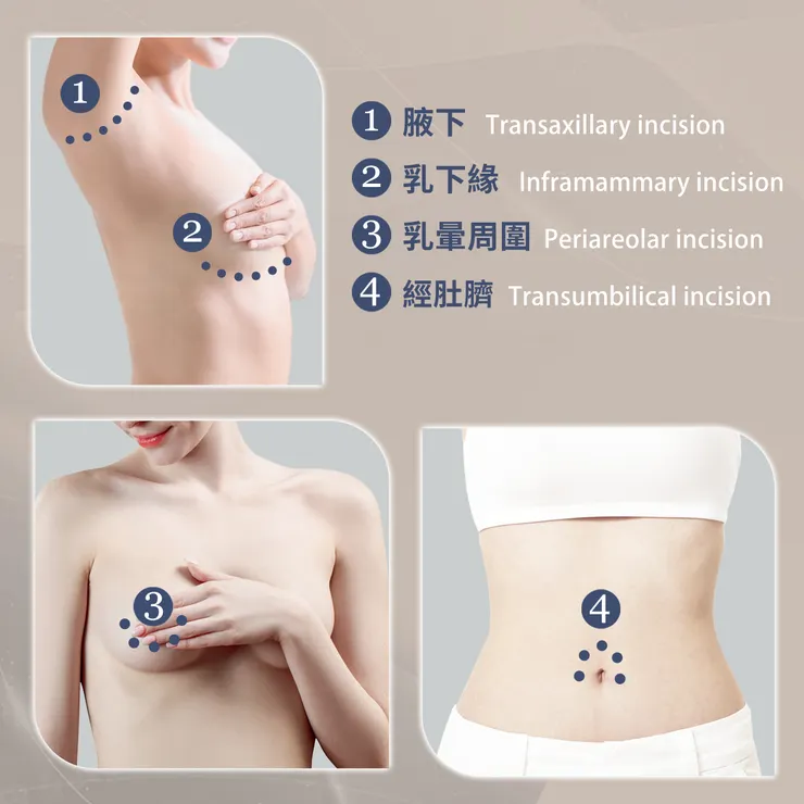 隆乳的手術切口選擇有4種：、腋下、乳下緣、乳暈周圍、經肚臍 ，每位醫師通常會有他比較推薦的手術切口，也會有他推薦的理由。蔡昀達醫師將為您解說不同手術切口的優缺點。