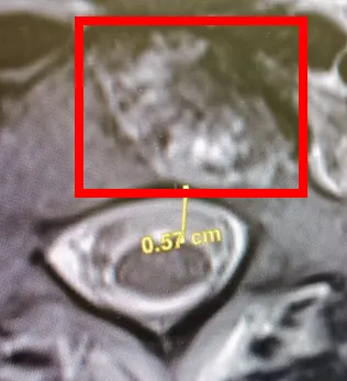 脊椎切面圖，紅框内為癌細胞侵蝕部分