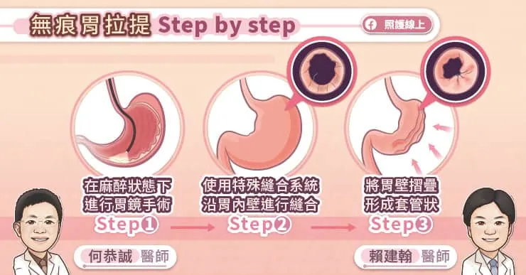 無痕胃拉提Step by step