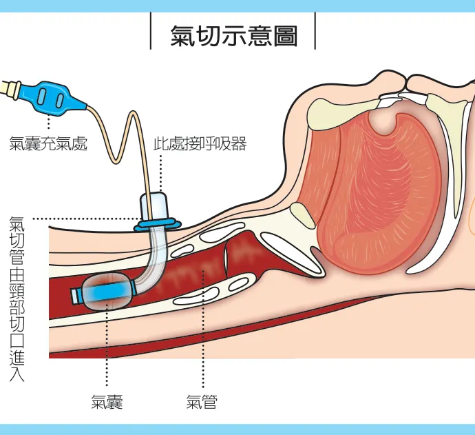 氣切管放置