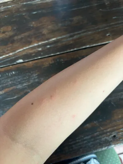 旅行中最常遇到的事——蟲蟲攻擊