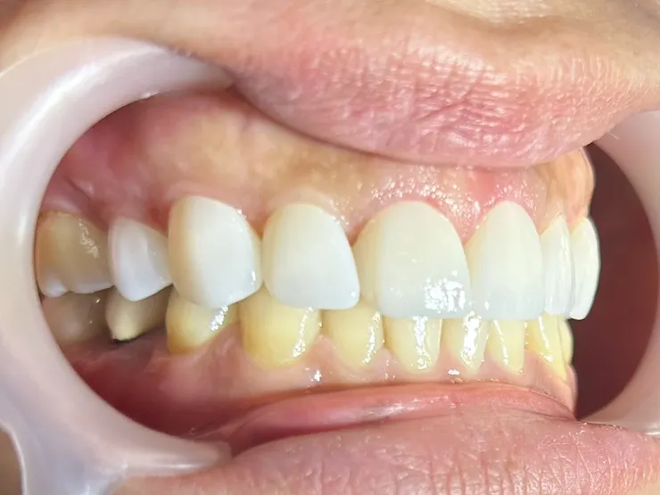 渥爾牙醫:自建數位牙技中心,讓美白貼片(鋯白貼片)成為最具性價比的牙齒美白選擇!