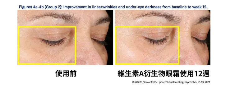 眼周保養成分怎麼選？