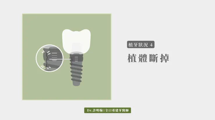 第4種植牙狀況：植體斷掉