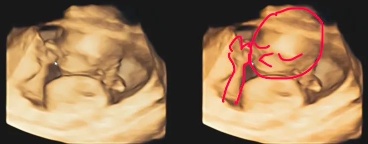 16w+3d已經可以從3D照片看出一些端倪