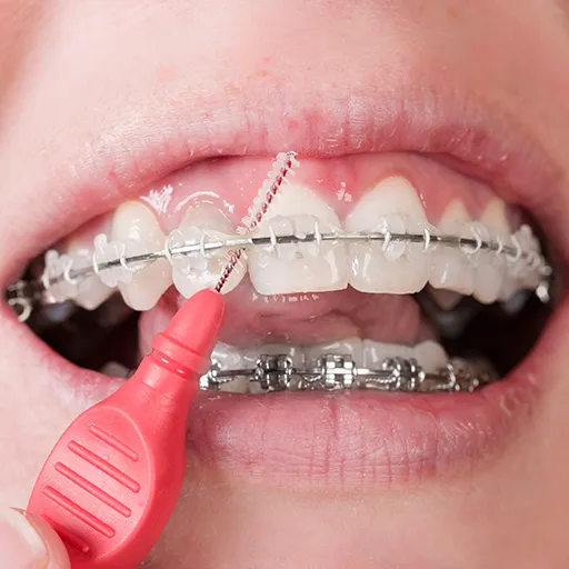 什麼是牙齒矯正？善貝口腔何麗珠醫生分享