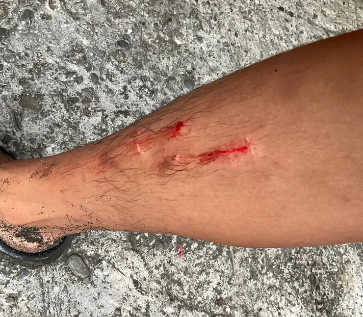 衝浪的傷口/Steven攝