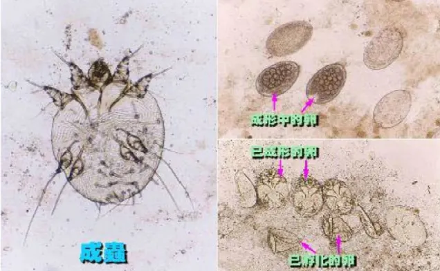 疥蟲KOH圖片(資料來源:網路)