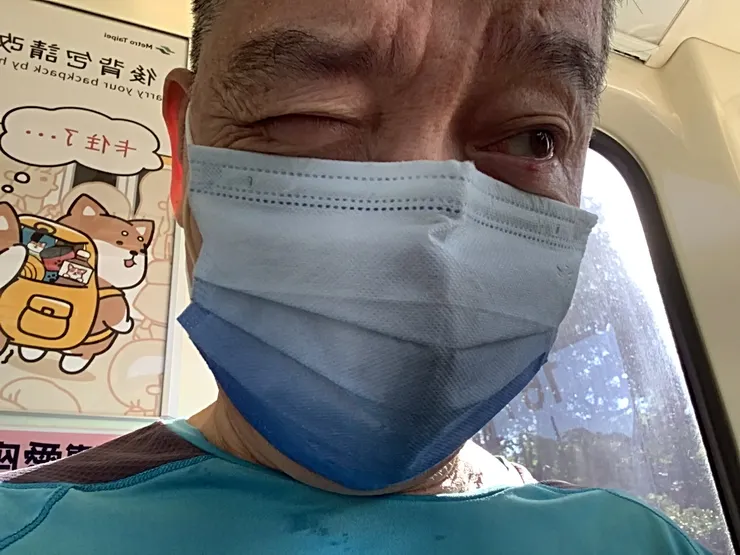 圖三:經過六週後的針眼改善,左眼下方紅腫疹子只剩下原來的1/5
