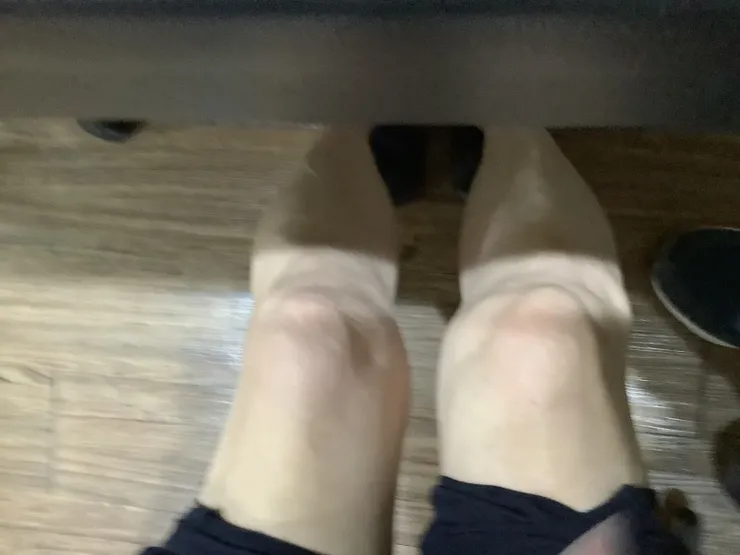 圖二:左右膝蓋產生不對稱的現象案例