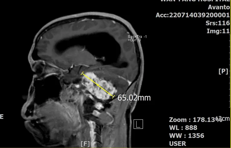 椰當年在MRI下的龐大身軀(矢狀剖面)
