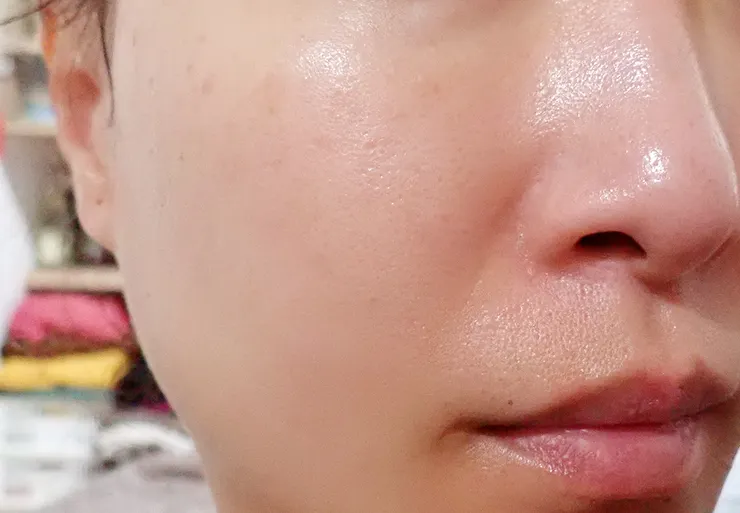 台北打皮秒│探索皮秒+蜂巢(超級鏡片ReFIX)-台北醫美診所推薦