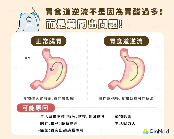 胃食道逆流是因為賁門出問題，不是因為胃酸過多